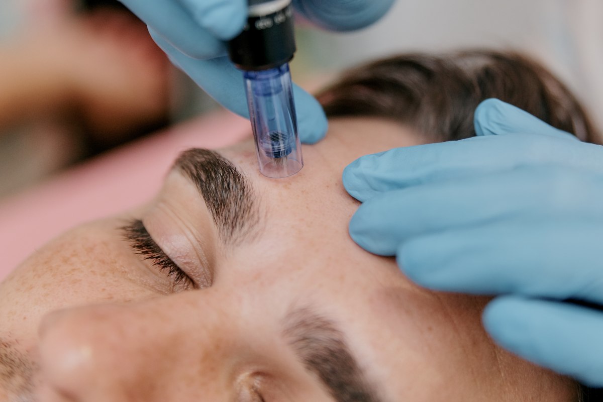 Aloe vera para cuidar tu piel tras un tratamiento de microneedling