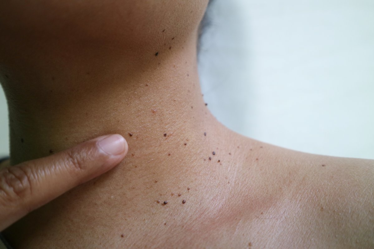 Cómo ayuda el aloe vera al cuidado de las pieles con queratosis seborreica